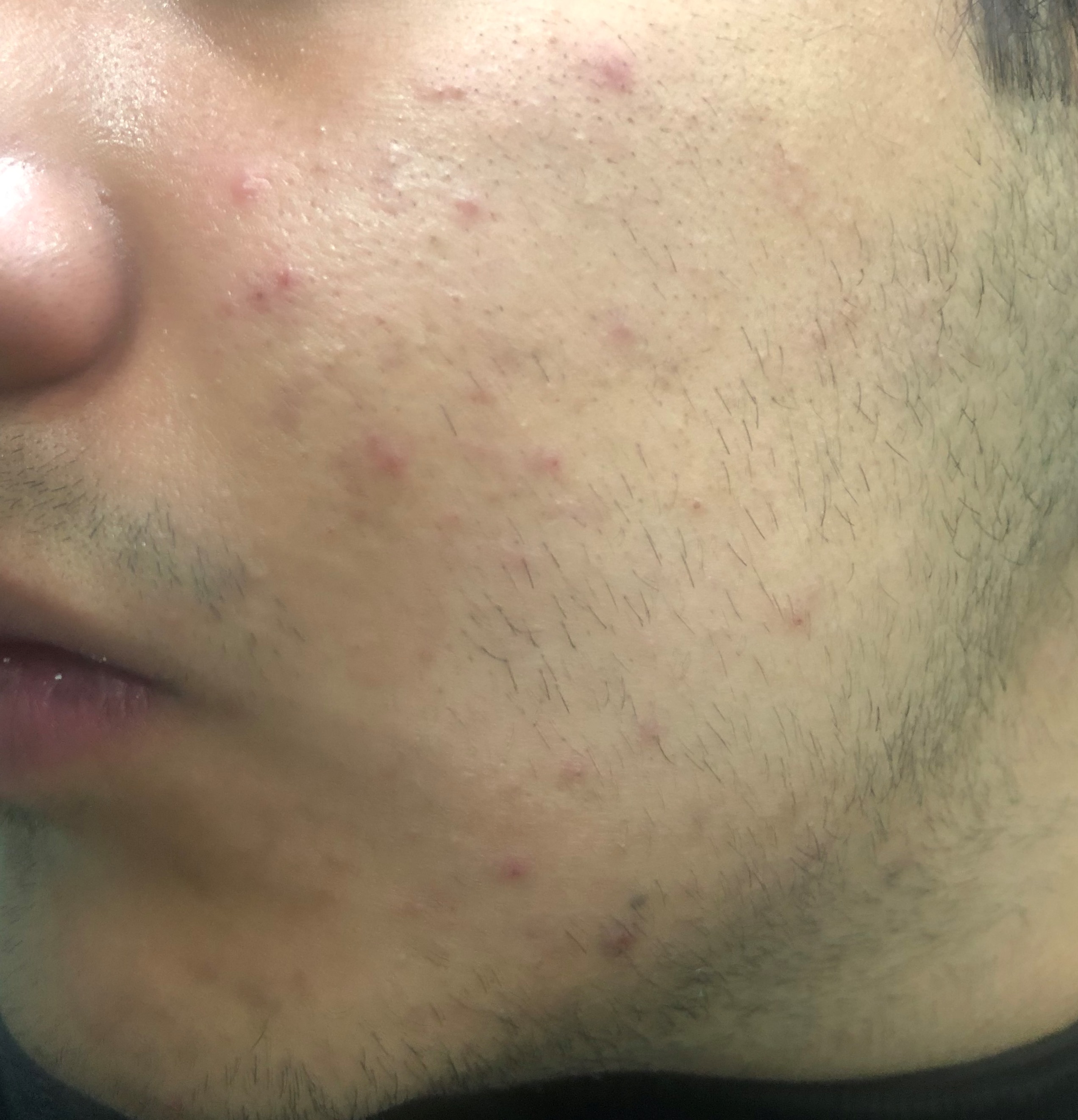 Casos de Acné - Antes y Después de Peelings